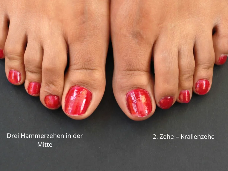 KrallenzehHammerze