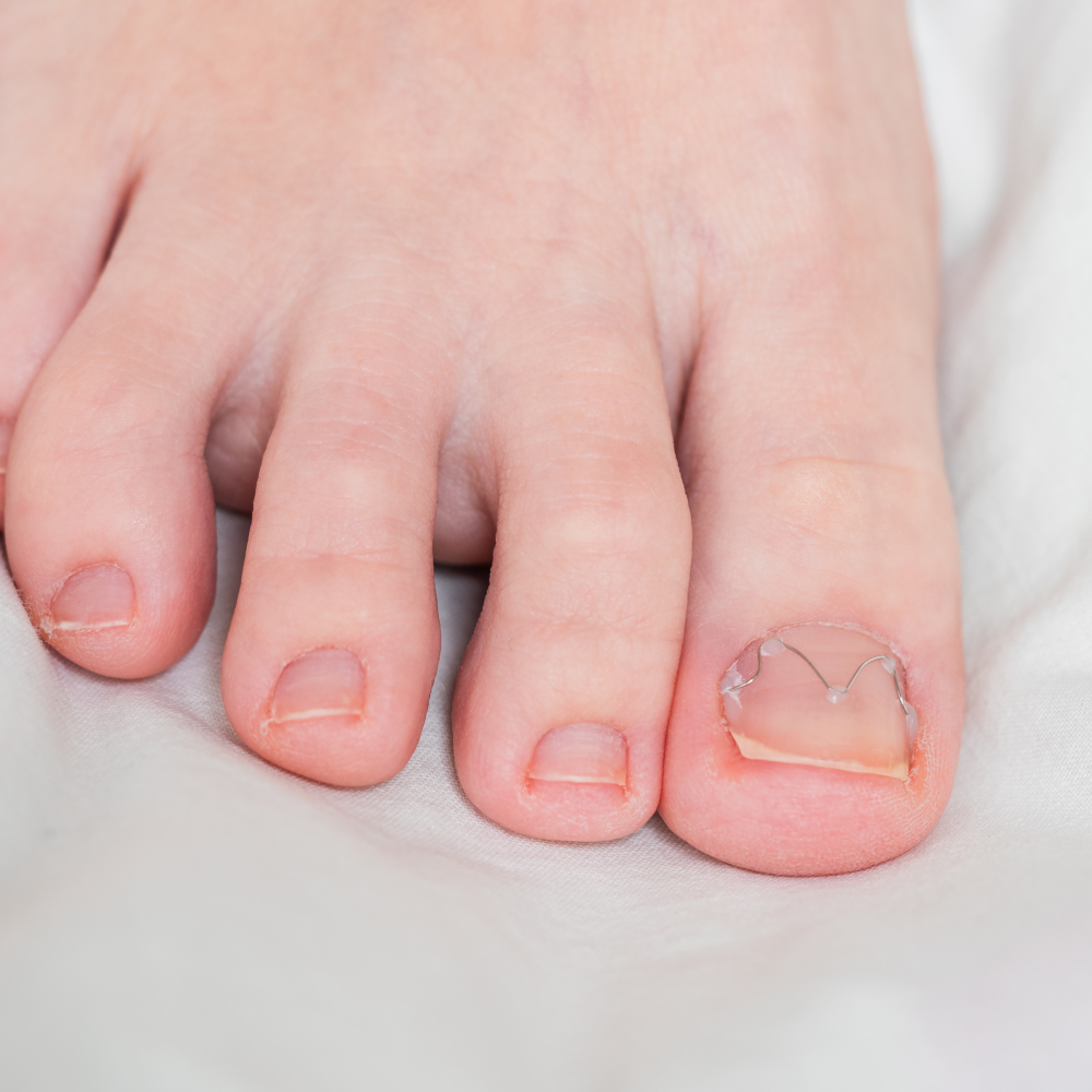 großer Zeh mit Metalklammer, geklebt