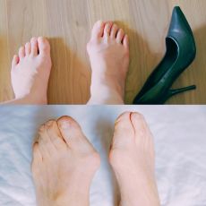 hallux valgus vererbbarkeit und entstehung dr gottlieb berlin