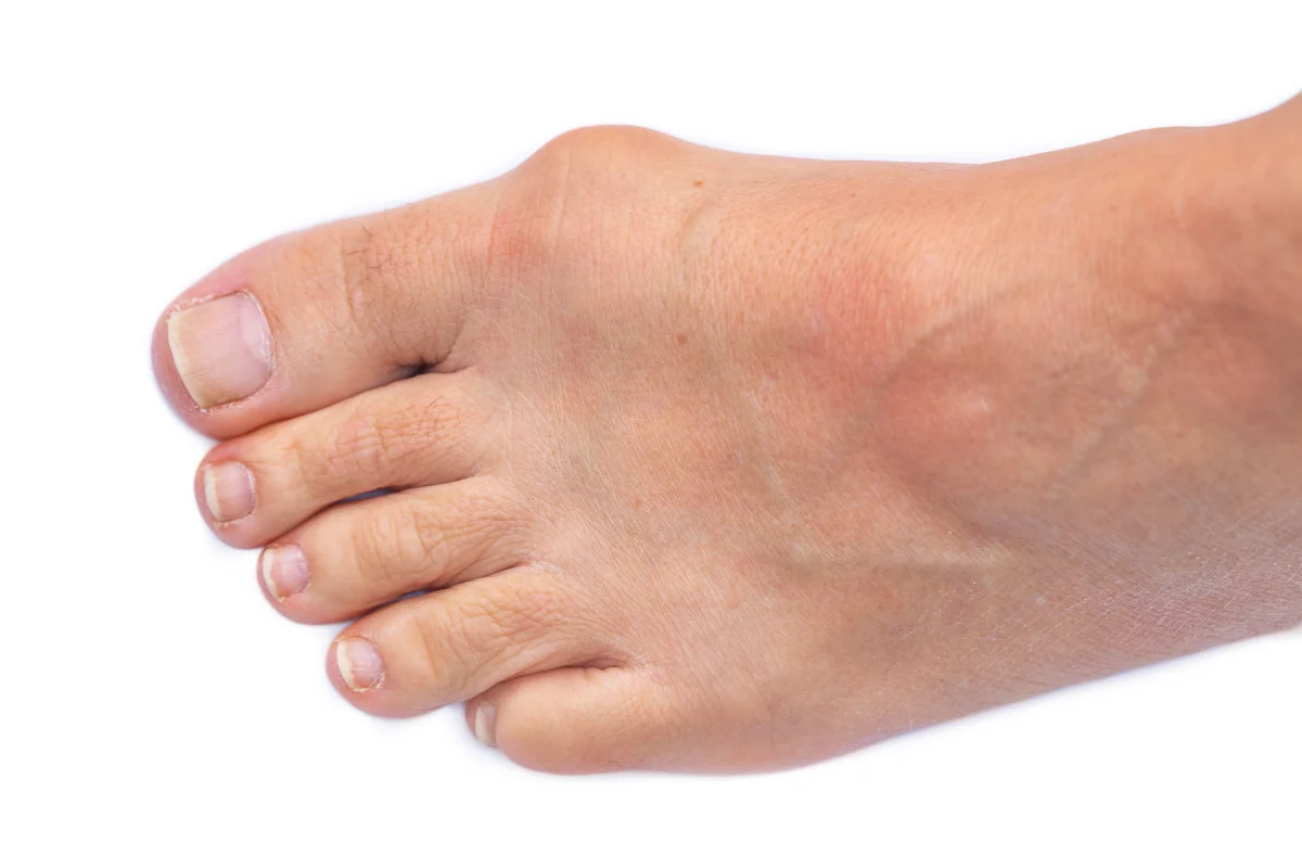 Hallux valgus OP
