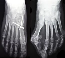 Hallux valgus Röntgen vor und nach der OP