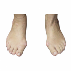 Hallux valgus vor OP