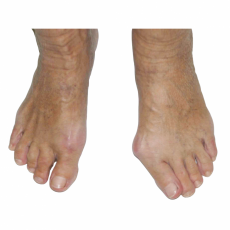 Hallux valgus vor und nach OP