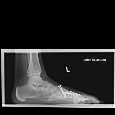 hallux varus korrektur nachher fallstudie 2