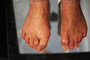 hallux varus korrektur nachher fallstudie 3