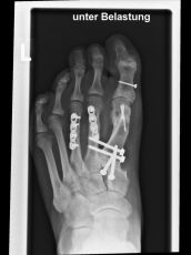 hallux varus korrektur nachher fallstudie
