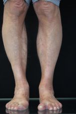 hallux varus korrektur vorher fallstudie 2