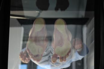 hallux varus korrektur vorher fallstudie 3