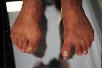 hallux varus korrektur vorher fallstudie